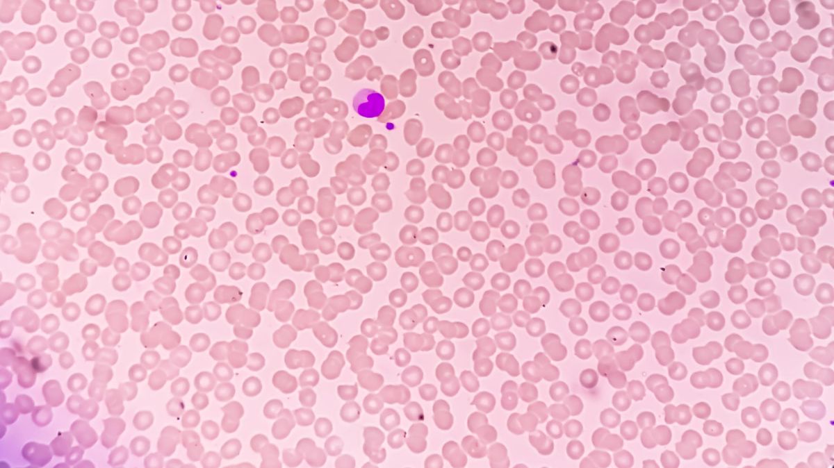 THROMBOCYTOPENIA-CALCULATOR